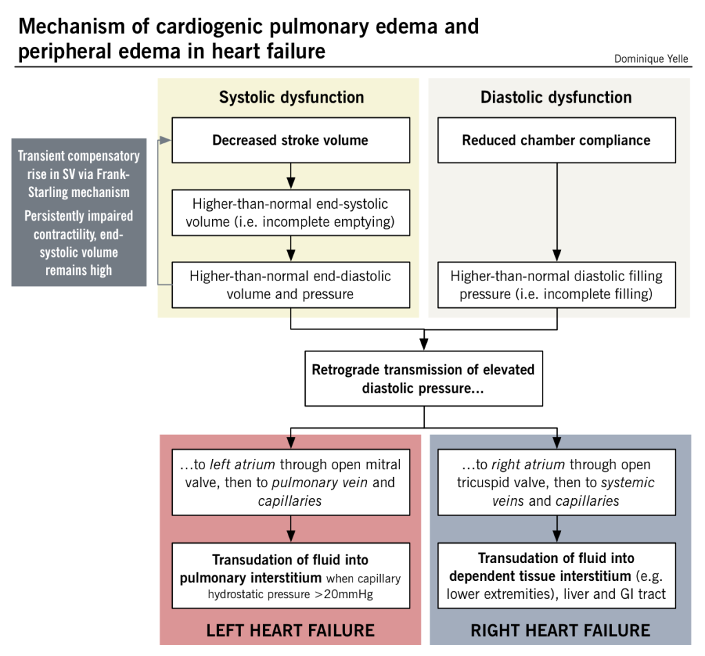Mechanism Of Cardiogenic Pulmonary Edema And Peripheral Edema In Heart